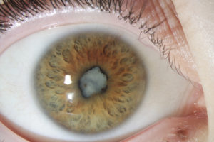 Cataracte blanche survenue chez un enfant de 7 ans présentant une uvéite sur arthrite juvénile idiopathique associée à une inflammation oculaire évoluant à bas bruit asymptomatique.