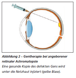 Gentherapie bei angeborener retinaler Achromatopsie