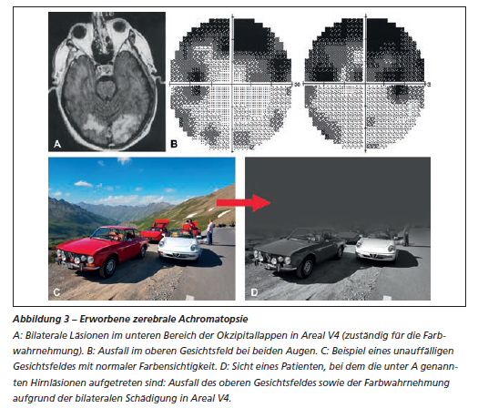Veranschaulichung einer zerebralen Achromatopsie