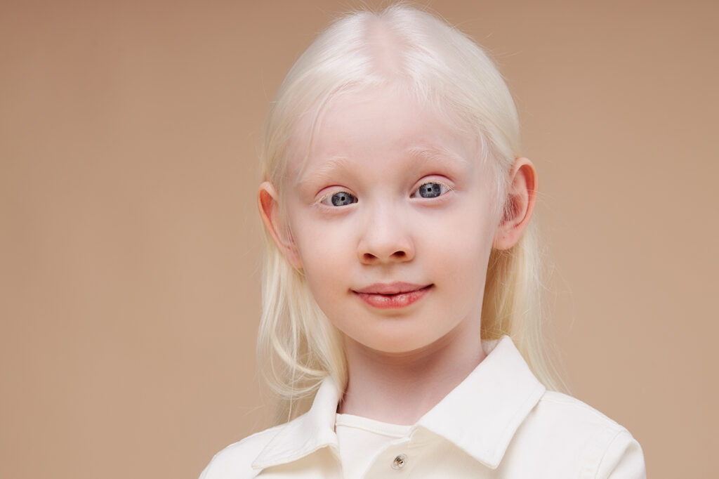 Une jeune fille atteinte d’albinisme regarde l'objectif.